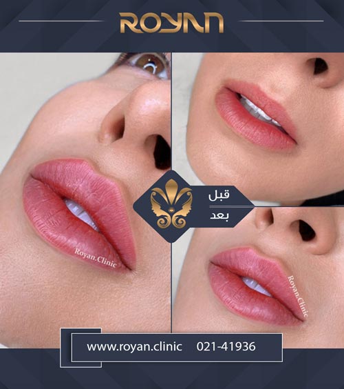 همه آنچه باید در مورد تزریق ژل و فیلر بدانید 8 نمونه تزریق ژل لب