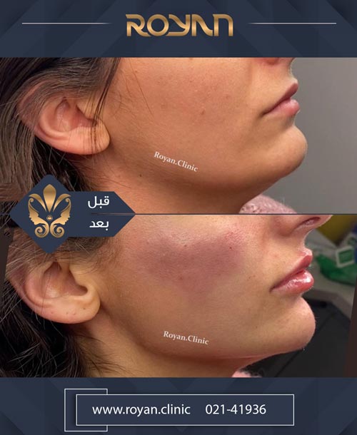 همه آنچه باید در مورد تزریق ژل و فیلر بدانید 9 تزریق ژل زاویه فک