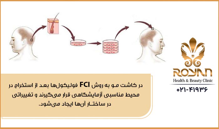 نحوه انجام کاشت مو به روش FCI