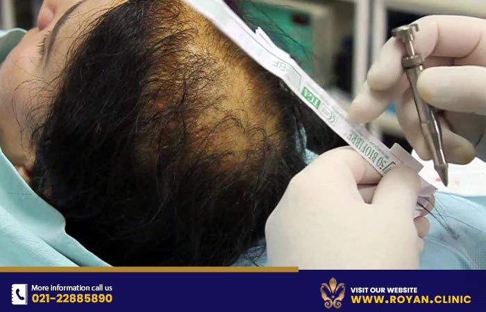 کاشت موی مصنوعی بایوفایبر