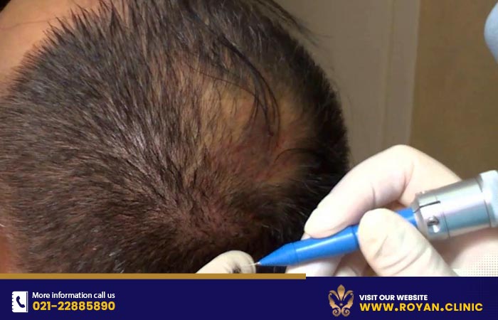 ترمیم موی مصنوعی به روش HRT