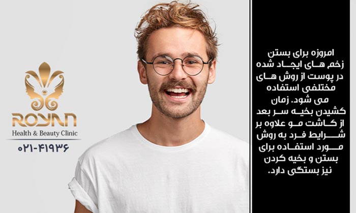 زمان کشیدن بخیه بعد از کاشت مو