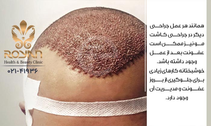 دلیل عفونت بعد از کاشت مو
