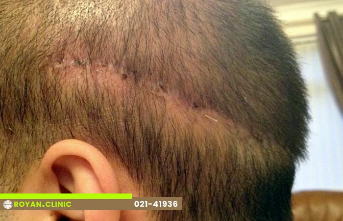 خط بخیه بعد از کاشت مو