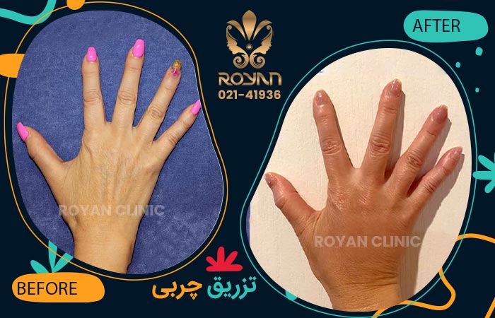 تزریق چربی دست