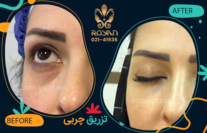 تزریق چربی زیر چشم