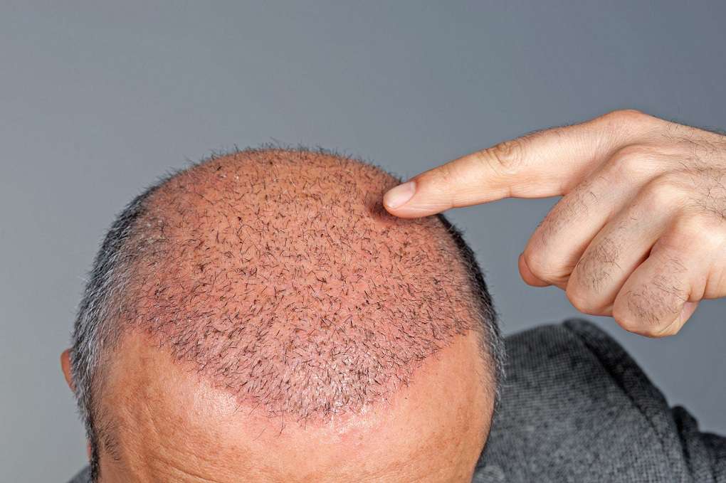 کاشت مو به روش FUE