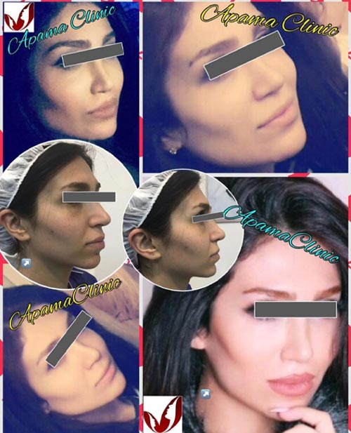 تزریق چربی به صورت
