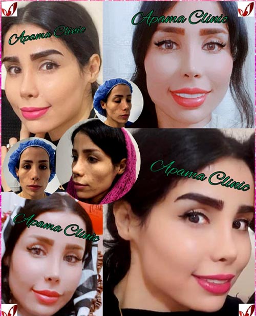 تزریق چربی