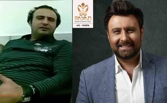 کاشت مو محمد علیزاده