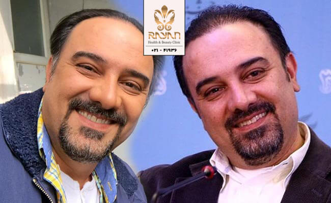 کاشت مو برزو ارجمند
