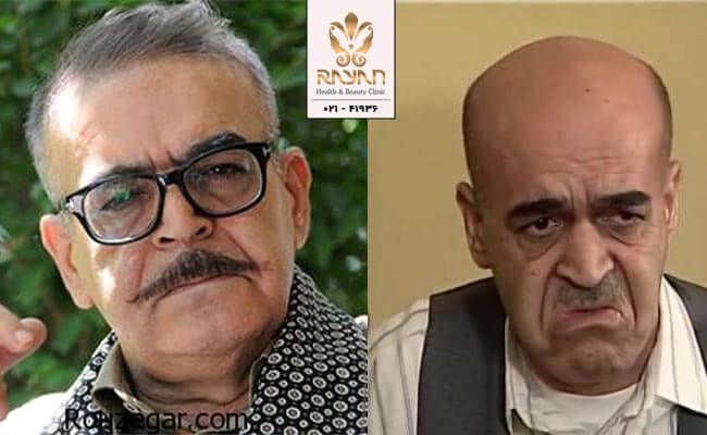کاشت مو حمید لولایی