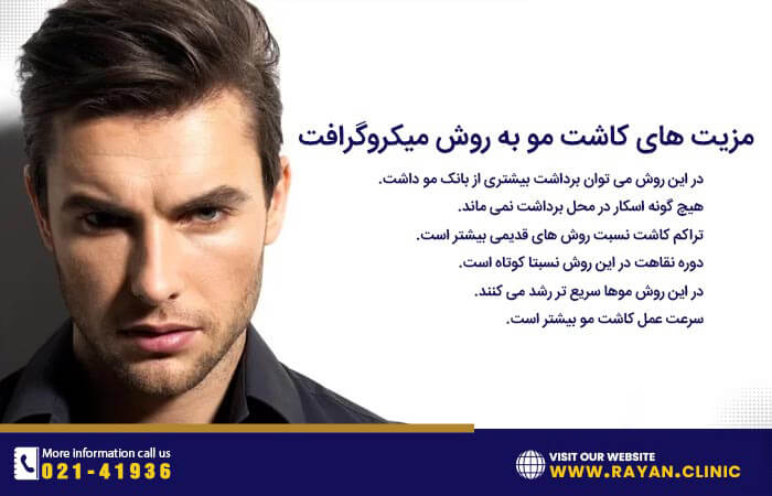 مزایای کاشت مو به روش میکروگرافت