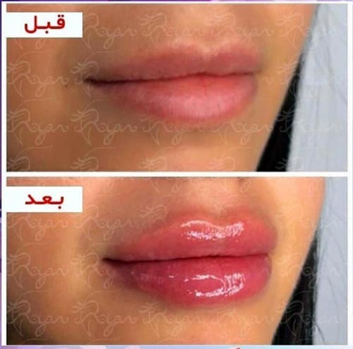 نمونه تزریق ژل لب