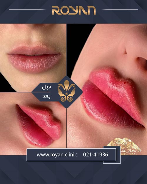 نمونه تزریق ژل لب روسی