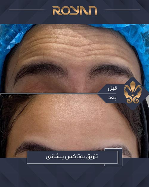 نمونه تزریق بوتاکس پیشانی