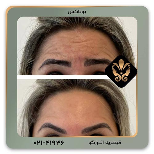 بوتاکس پیشانی
