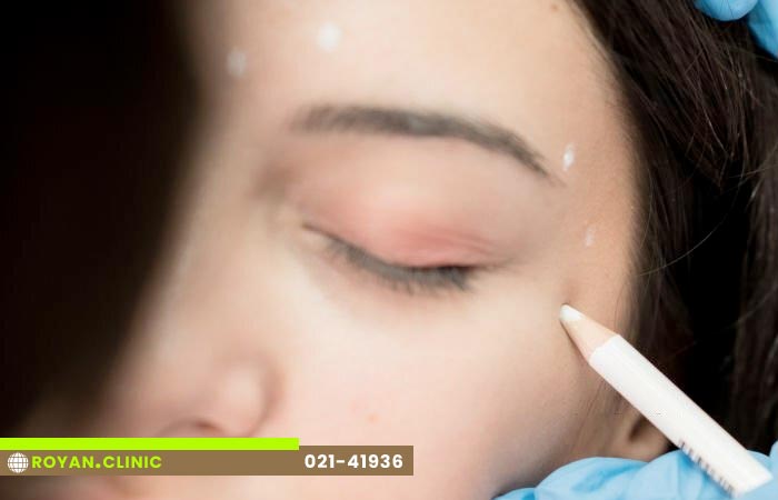 توصیه های بوتاکس