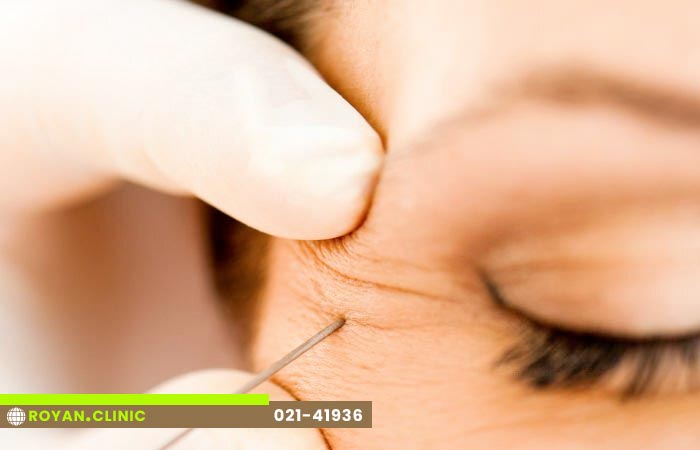 بوتاکس پنجه کلاغی