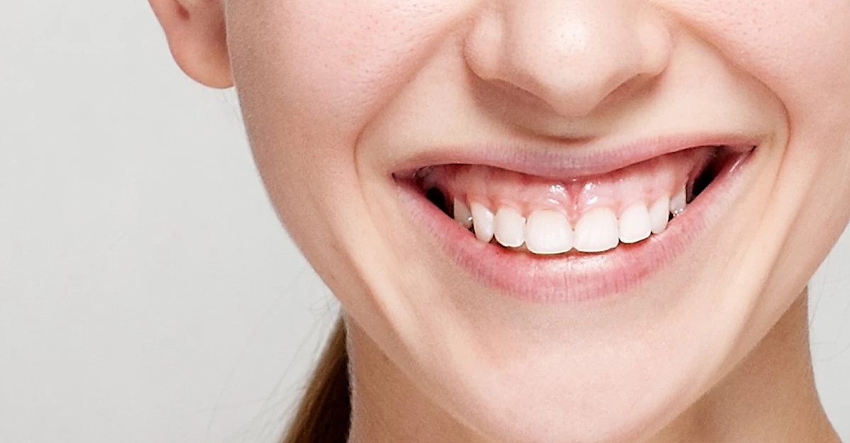 بوتاکس برای لثه و لبخند لثه ای چیست و چطور انجام می شود؟