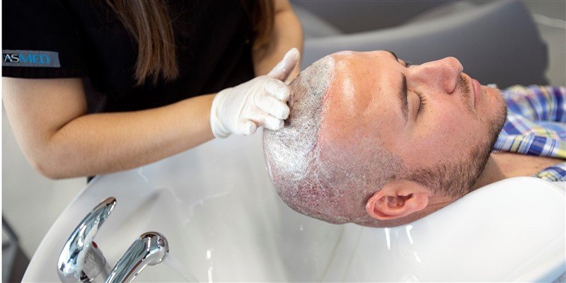 تورم بعد از کاشت مو چگونه از بین میرود؟