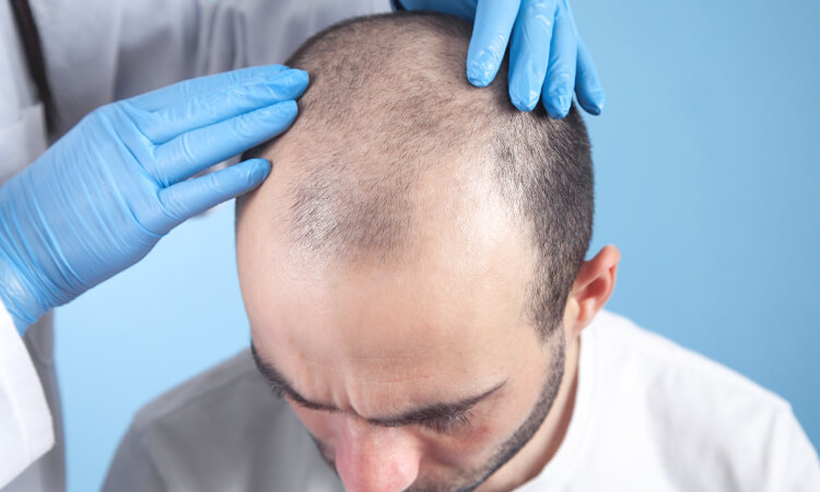 کاشت مو بدون جراحی