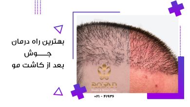 بهترین راه درمان جوش بعد از کاشت مو