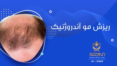 ریزش موی آندروژنیک