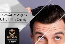 تفاوت کاشت موی FIT و SUT