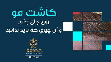 کاشت مو روی جای زخم