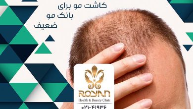 کاشت مو برای بانک موی ضعیف