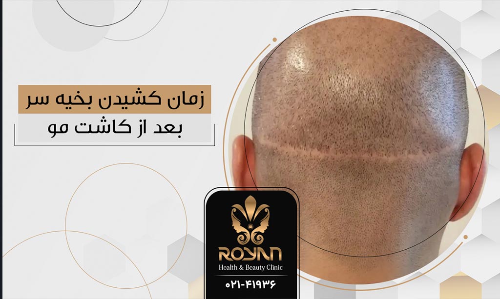 بخیه بعد از کاشت مو