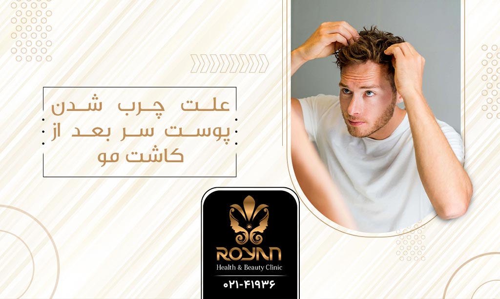 چرب شدن پوست سر بعد از کاشت مو