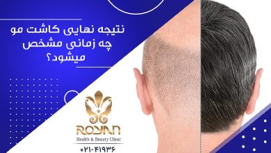 کاشت مو بعد از 5 ماه