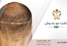 کاشت مو به روش FUT