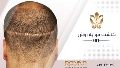 کاشت مو به روش FUT
