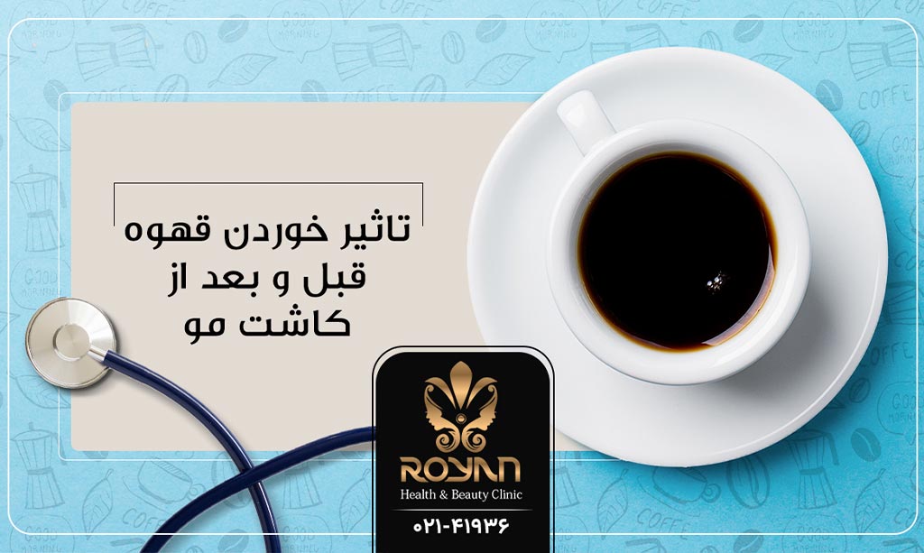 قهوه بعد از کاشت مو