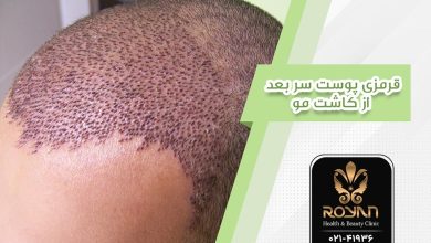 قرمزی بعد از کاشت مو
