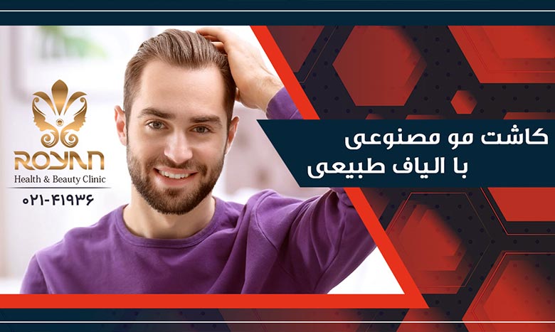 کاشت مو با الیاف نانو