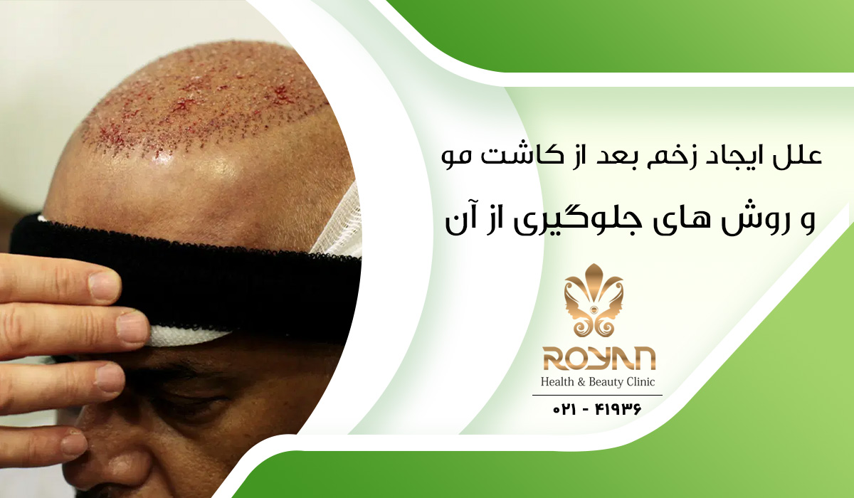 ترمیم زخم بعد از کاشت مو