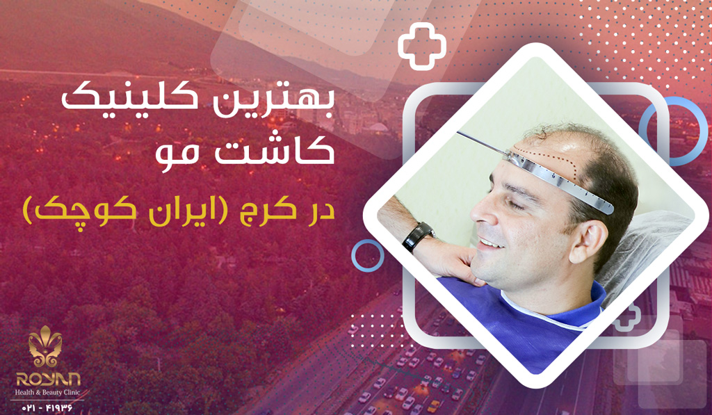کلینیک کاشت موی کرج