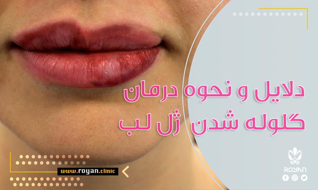 علت گلوله شدن تزریق ژل