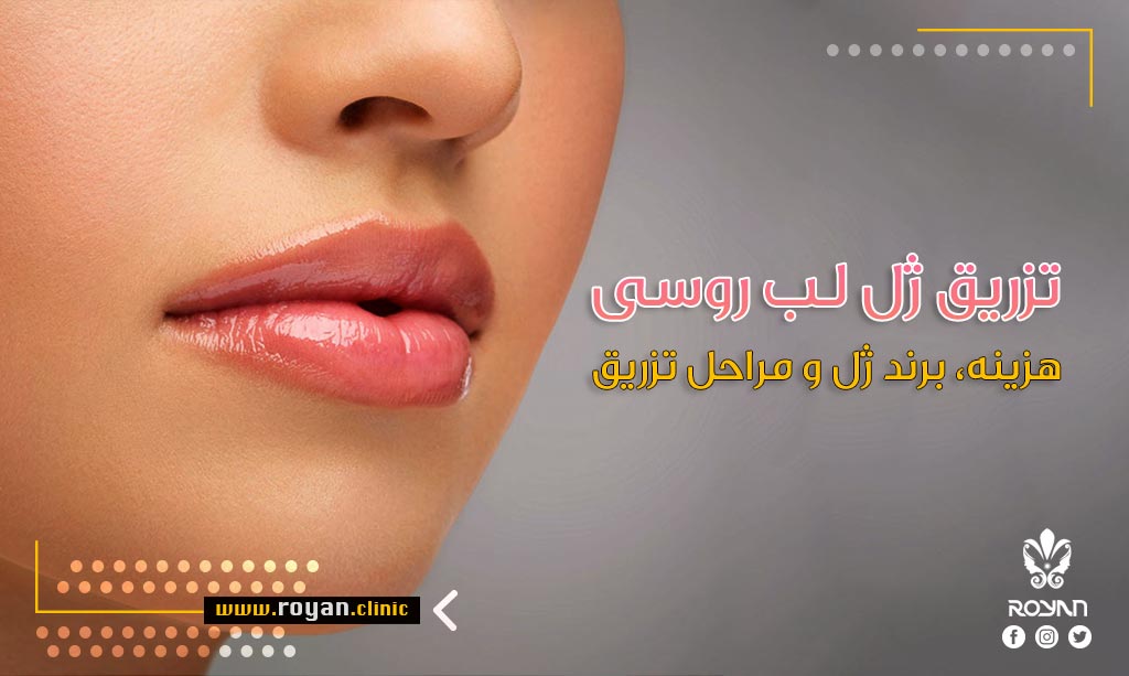 تزریق ژل لب روسی